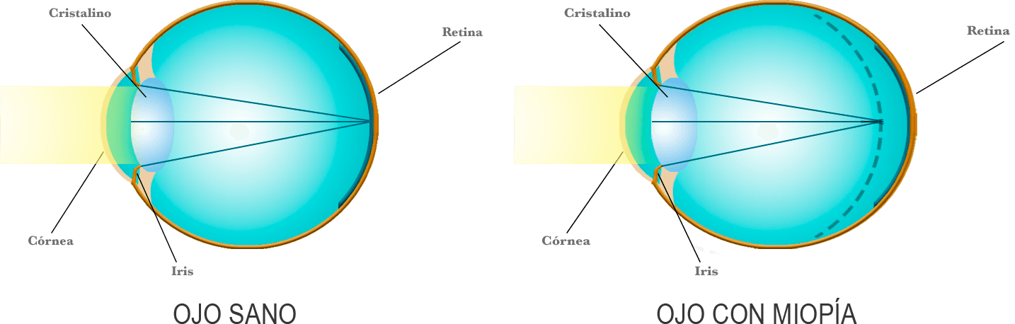 http://www.oculaser.es/img/miopia-detallada.png